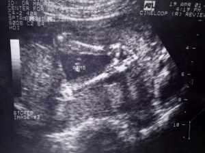 Ultrasound Photo